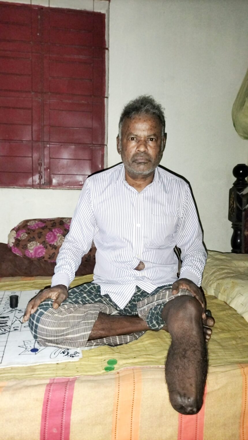 একটি কৃত্রিম পা সংযোজনে অসহায় বাবুল দেব নাথের আকুতি - Surma Times | Sylhet News