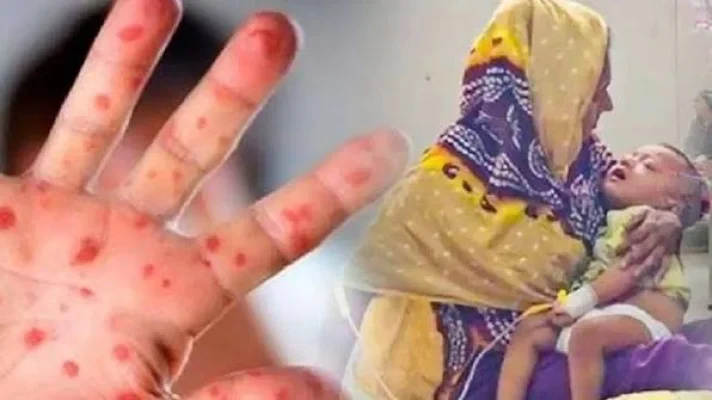 হামে আরও ৭ শিশুর মৃত্যু, মোট মৃত ৬৪৫ 1 হামে আরও ৭ শিশুর মৃত্যু, মোট মৃত ৬৪৫ - Surma Times | Sylhet News